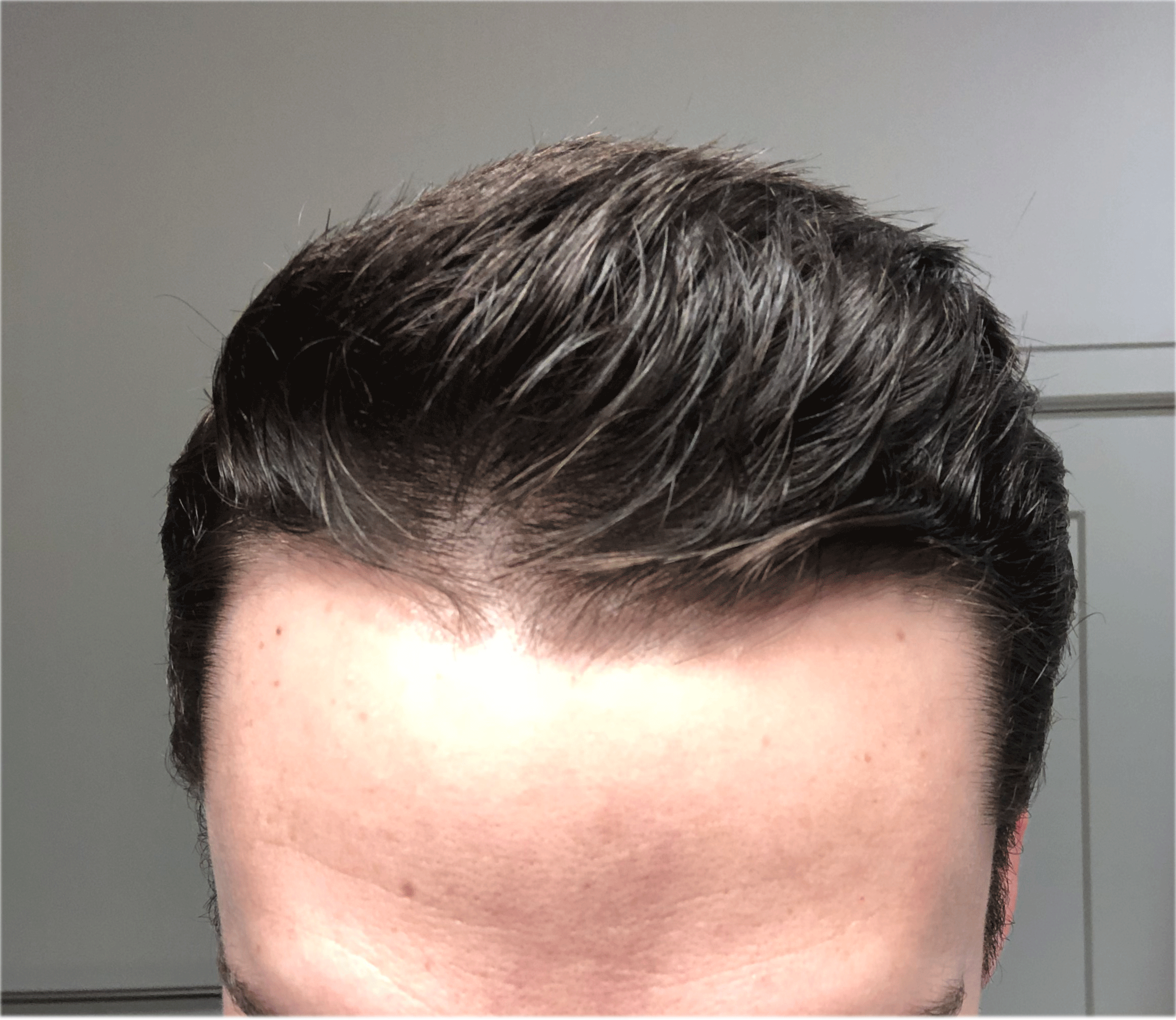 Front of hairline from above